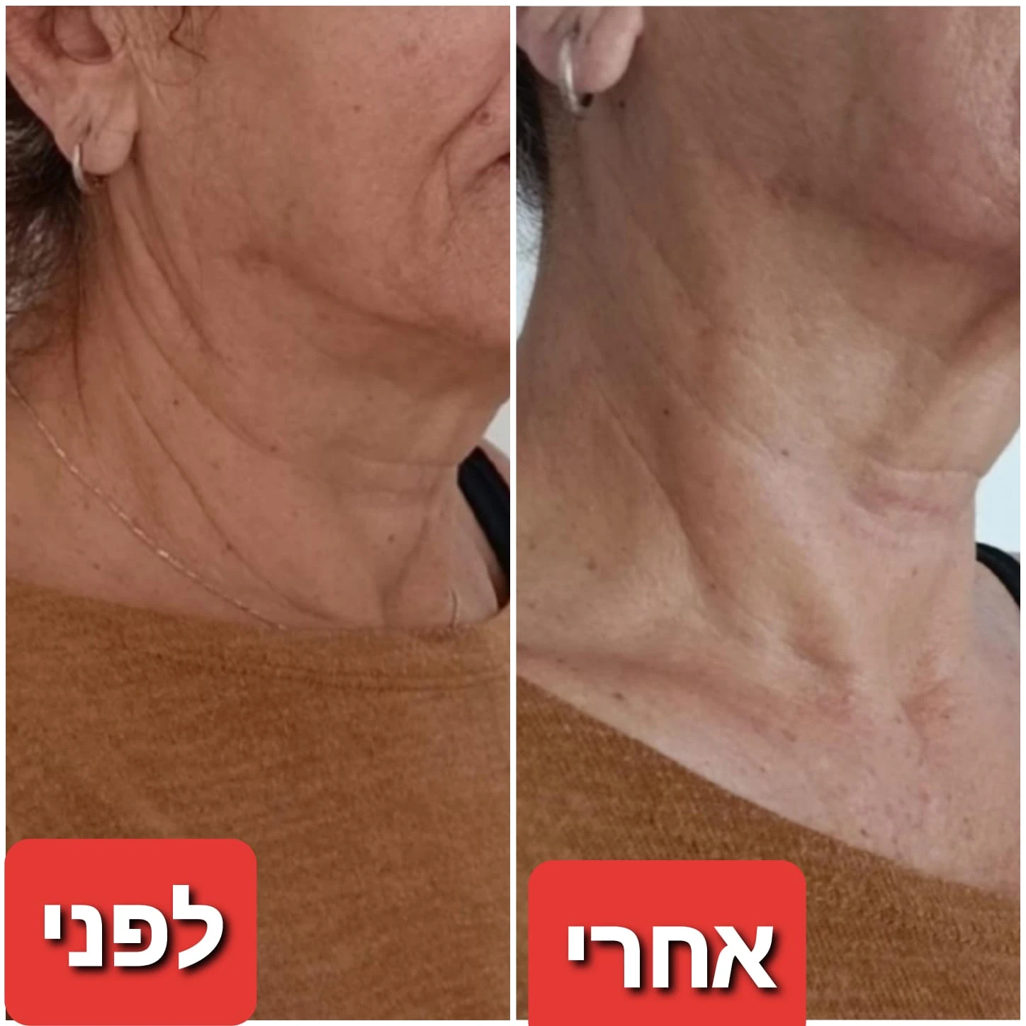 טיפולי פנים: אנטי אייגי'נג + גלי רדיו RF + מזותרפיה