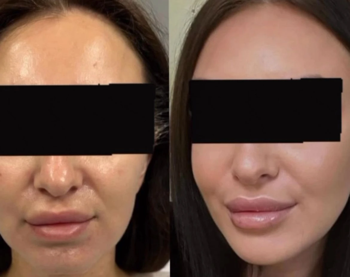 טיפולי אסתטיקה (הזרקות)