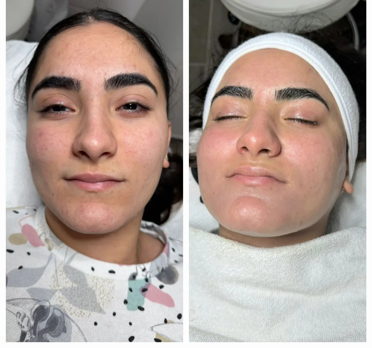 טיפול באקנה 