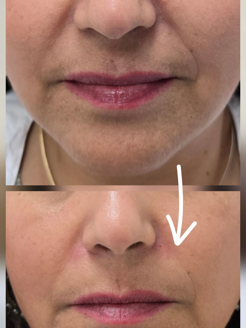 פיסול ועיצוב בחומצה היאלורונית