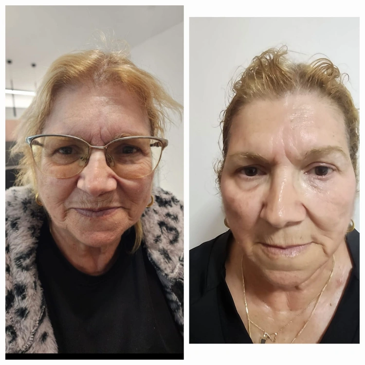 טיפולי RF למיצוק העור והעלמת קמטים