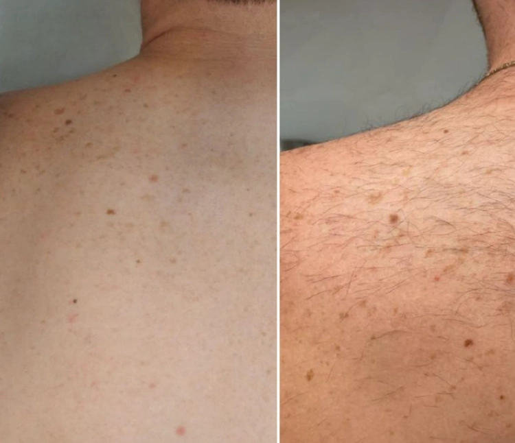 טיפולי לייזר להסרת שיער ללא כאבים