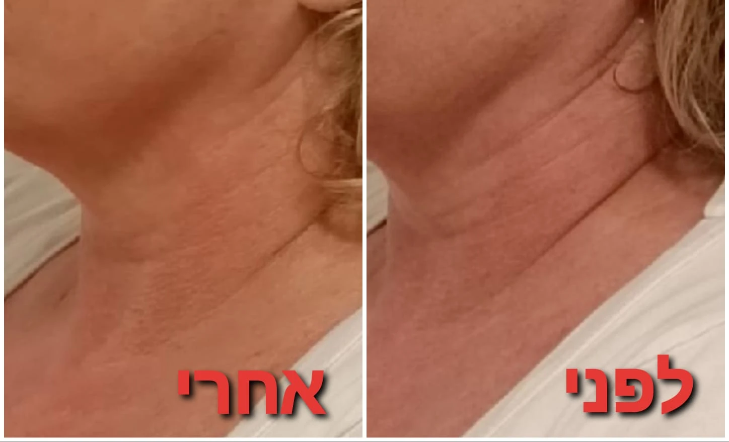 טיפולי פנים: אנטי אייגי'נג + גלי רדיו RF + מזותרפיה