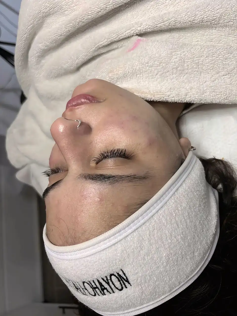 טיפול באקנה 