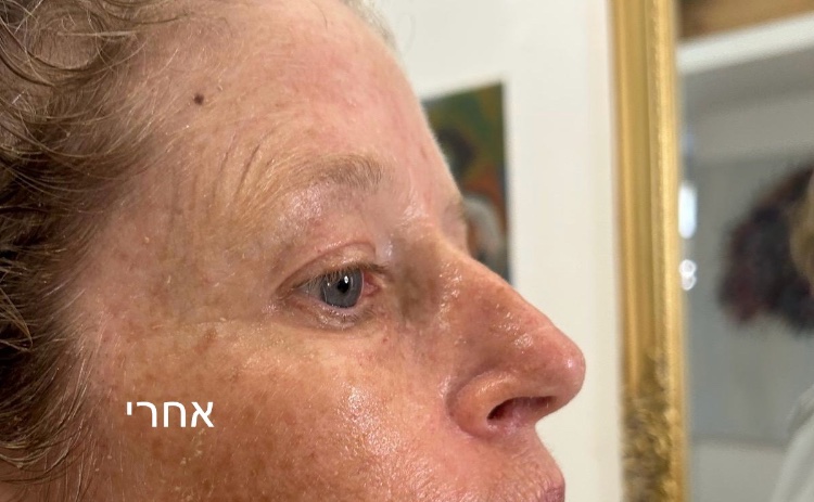 טיפול בקמטים /פלמה Dush פלזמה Nidel