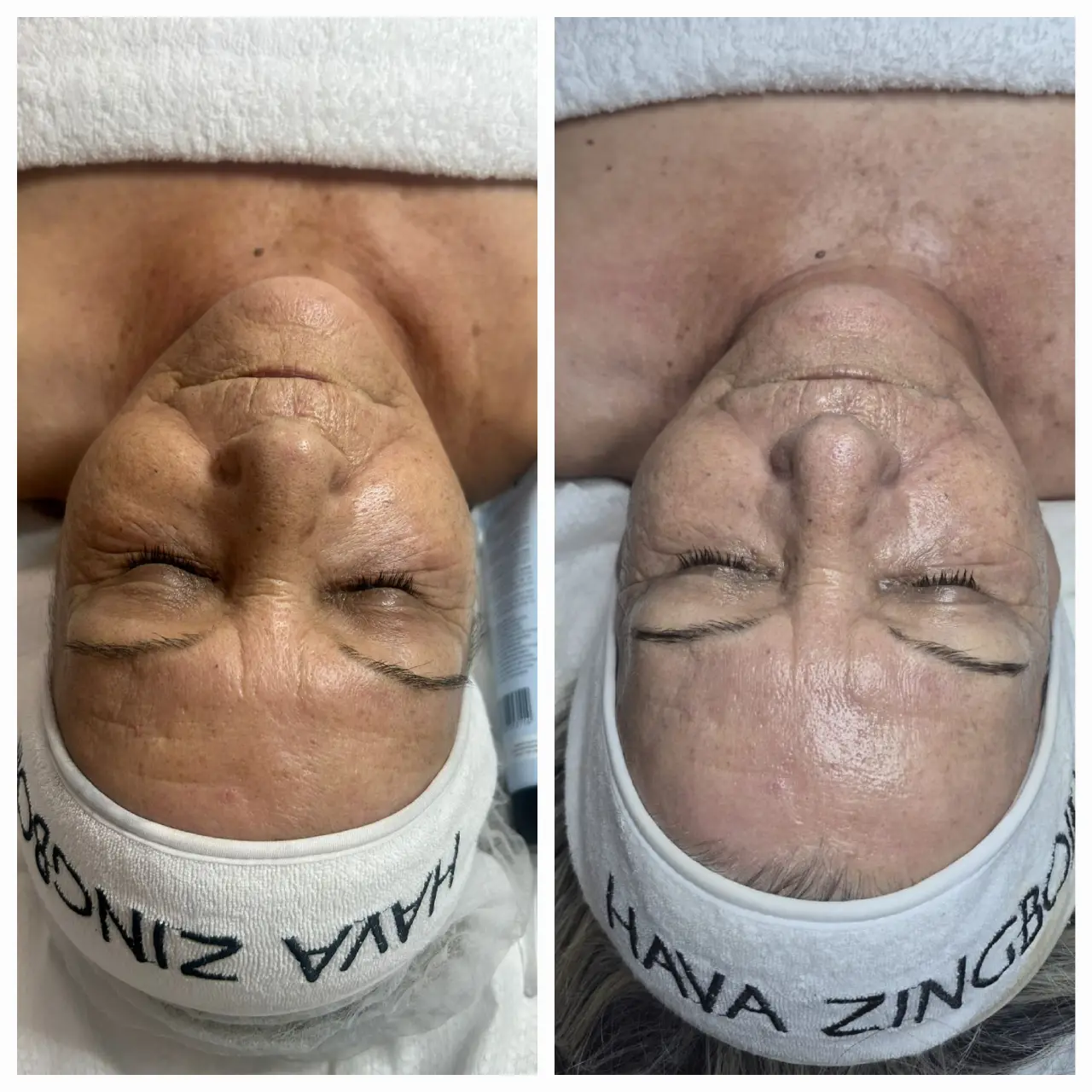 טיפול אייגינג  ומיצוק העור בשיטת RF