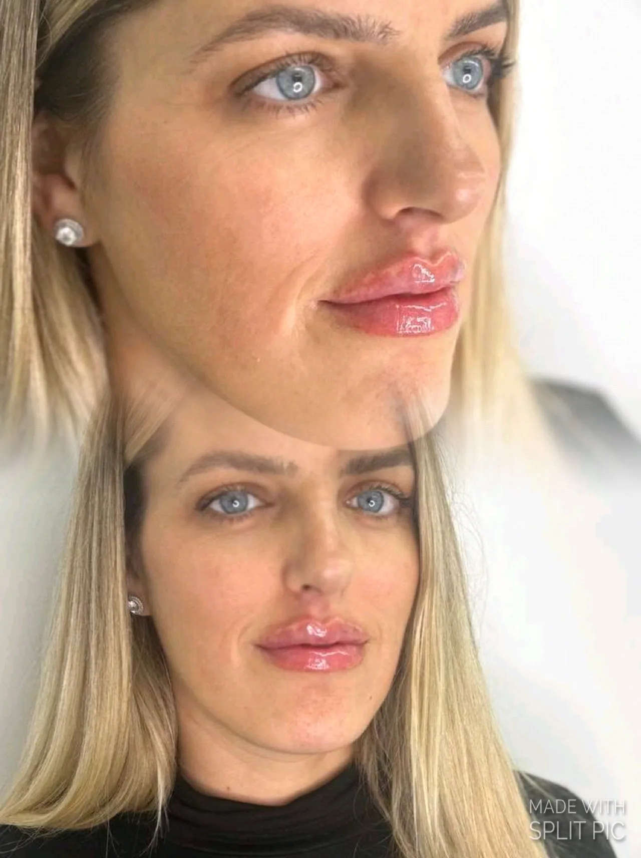 בוטוקס פול פייס וצוואר