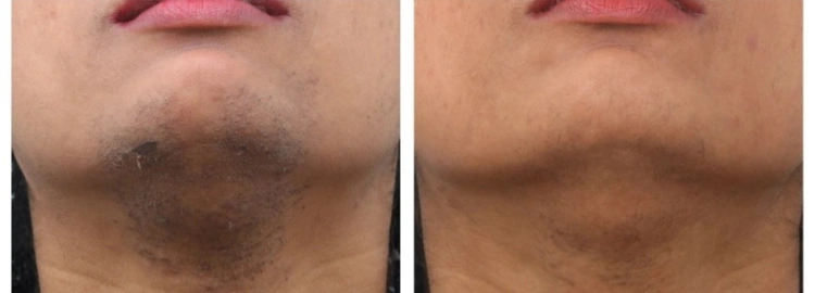 טיפולי לייזר להסרת שיער ללא כאבים