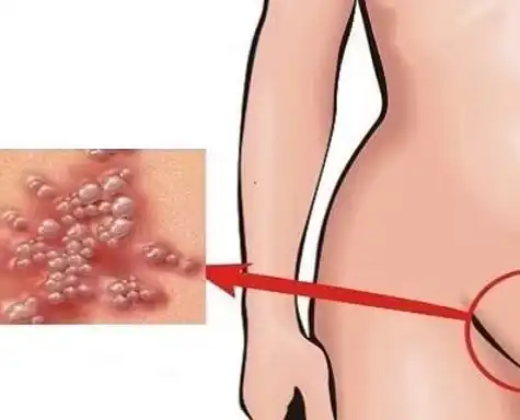 משחה לטיפול ביבלות קונדילומה לטיפול מקומי, 30 מל