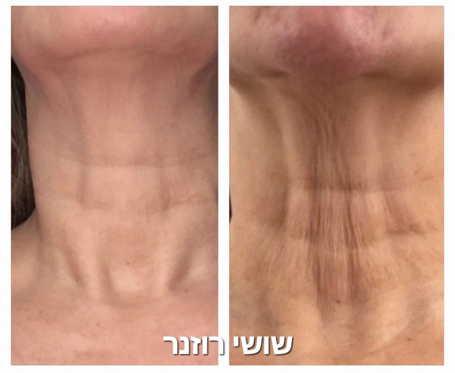 טיפול הייפו (HIFU)