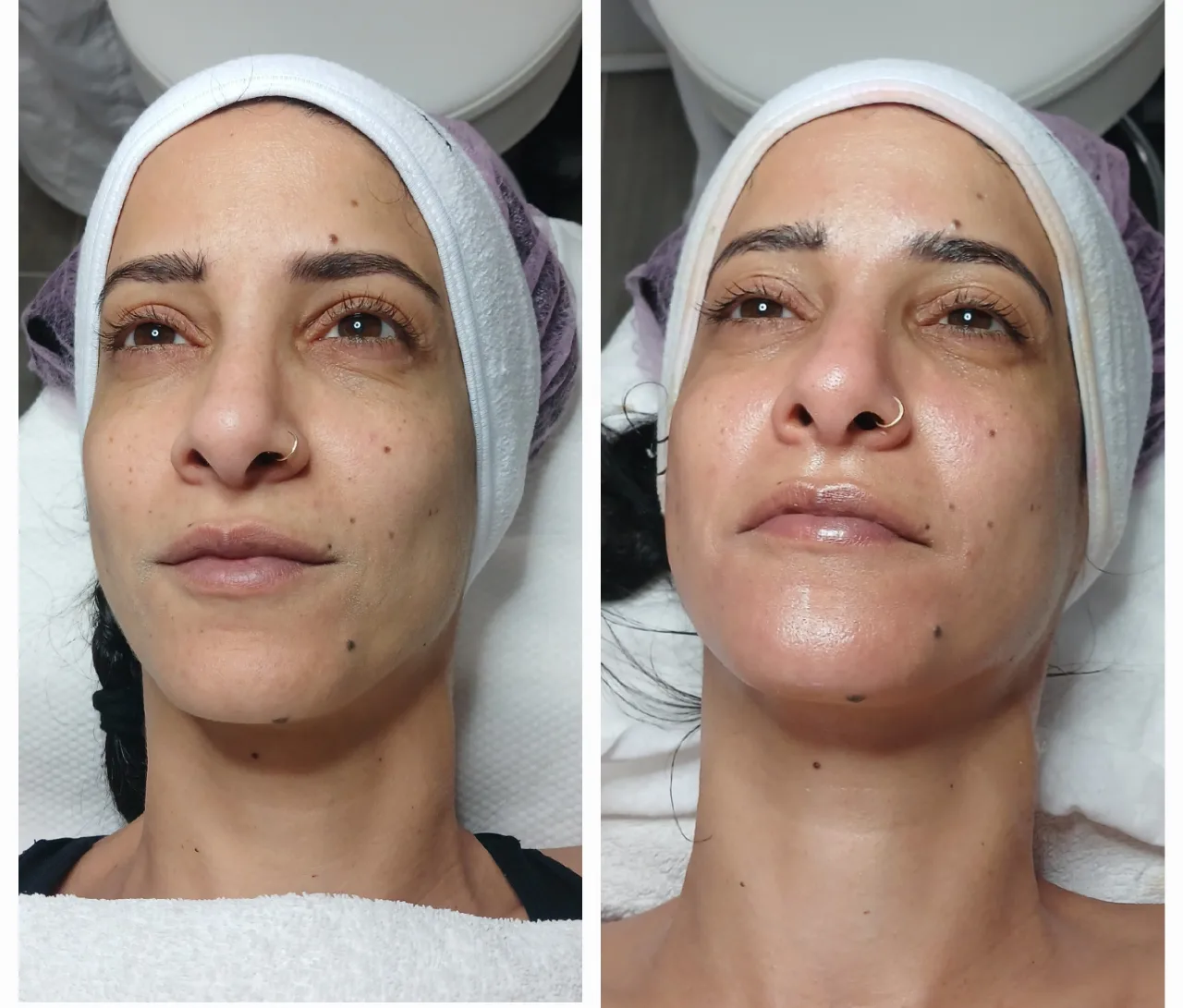 טיפול אייגינג  ומיצוק העור בשיטת RF