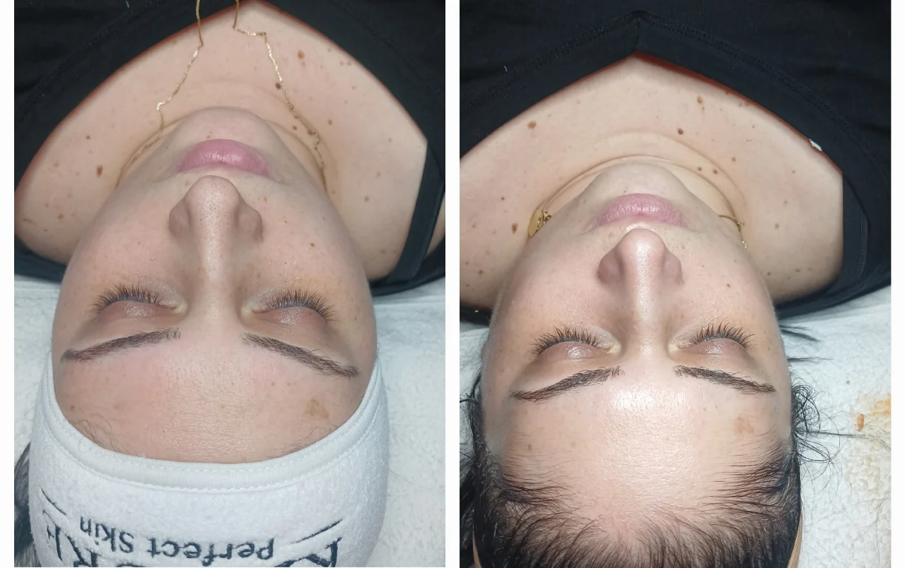 טיפול פנים קלאסי