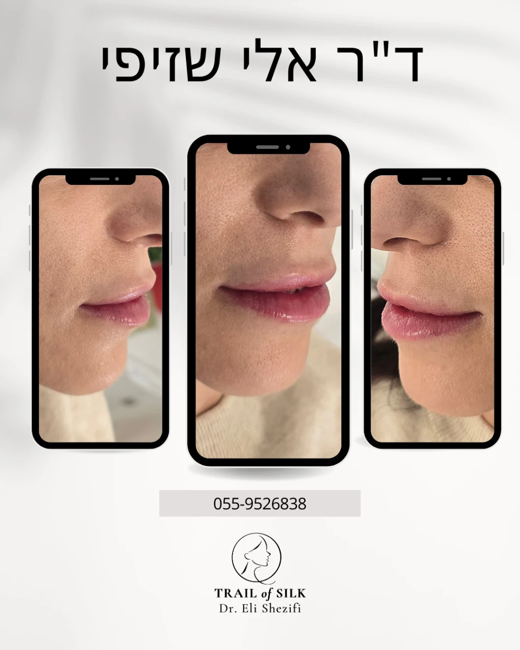 מילוי שפתיים