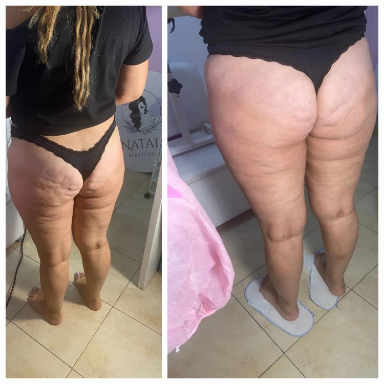 המסת שומן ומיצוק העור