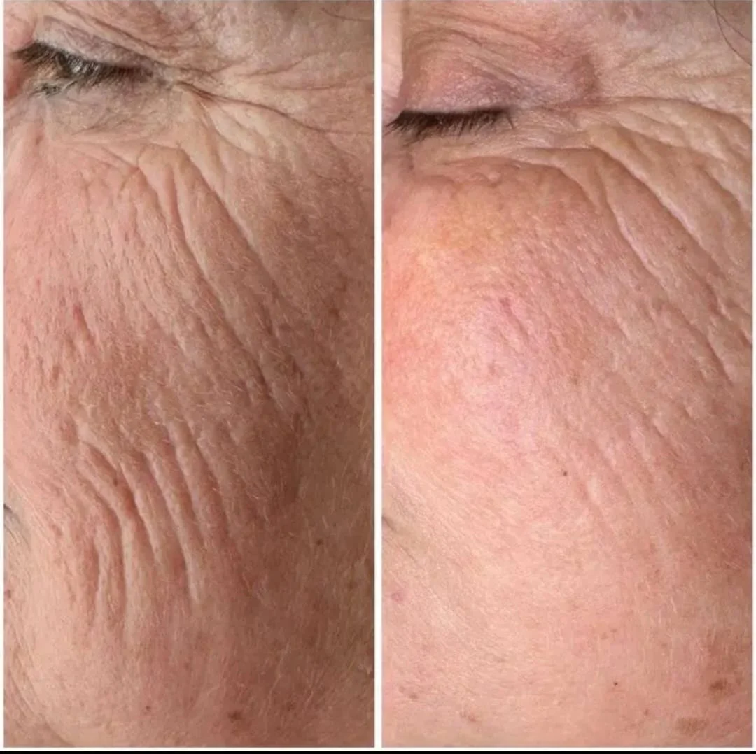 טיפול הייפו (HIFU)