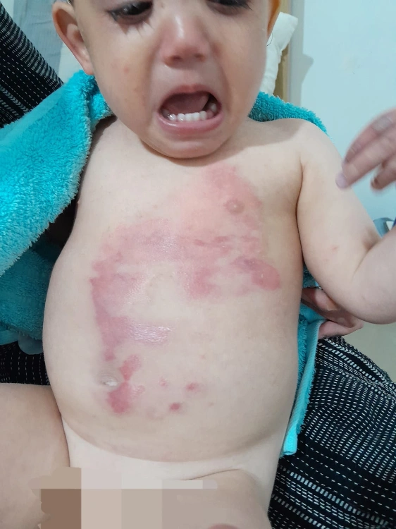 קצב ריפוי בלתי נתפס - כוויה לתינוק שנשפך עליו מים חמים