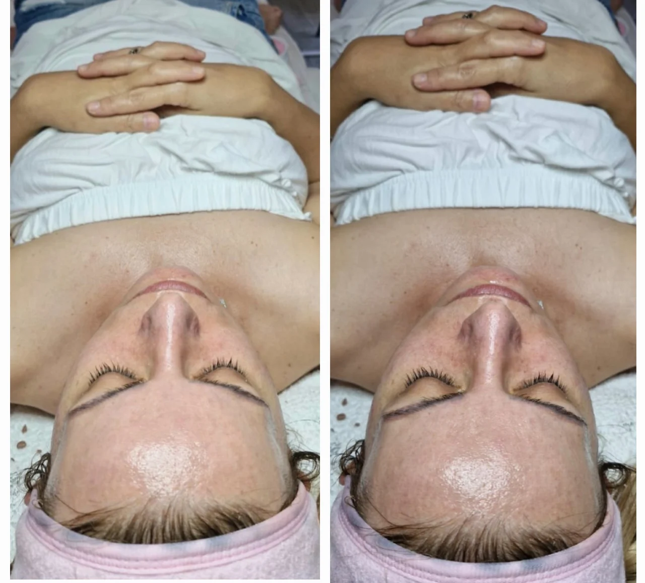 טיפול פנים קלאסי