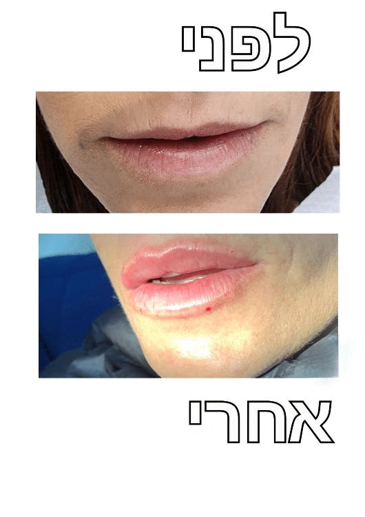 עיצוב שפתיים