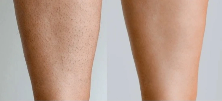 טיפולי לייזר להסרת שיער ללא כאבים