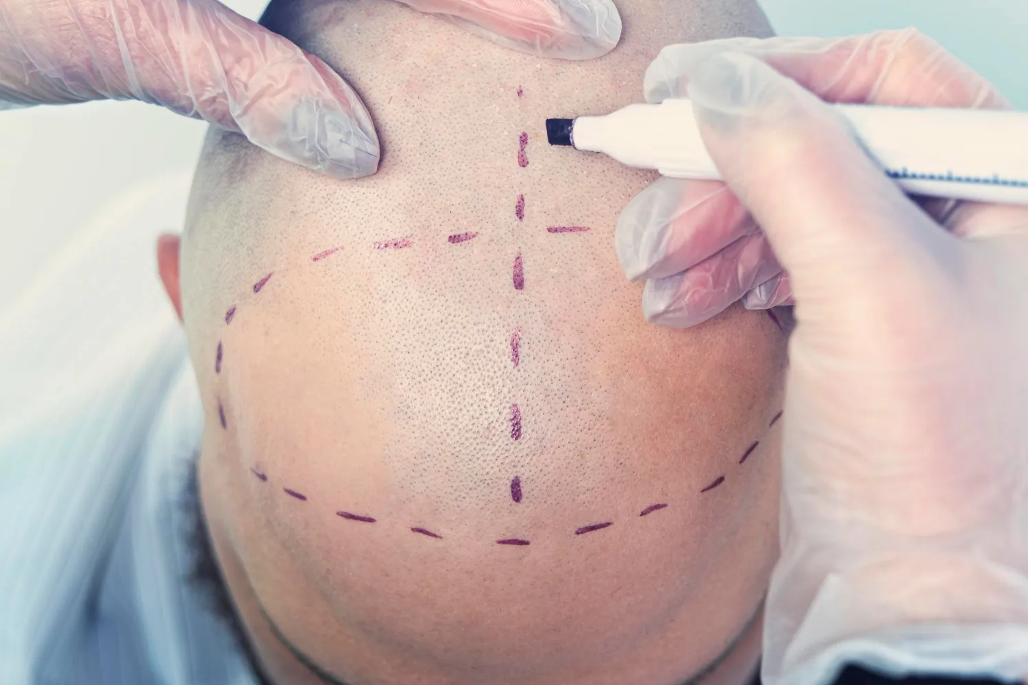 השתלות שיער טיפול בבעיות נשירה