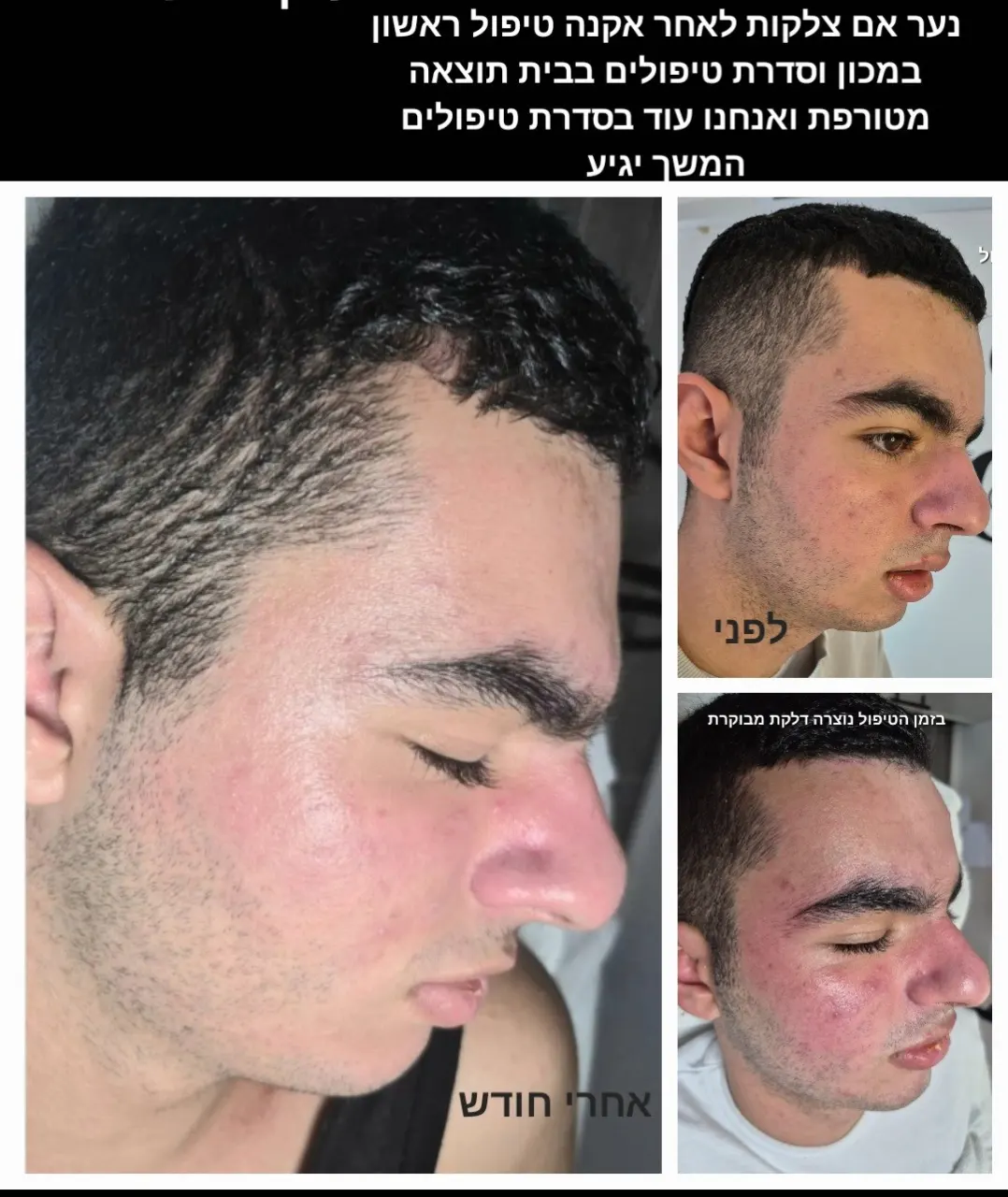 טיפול באקנה 