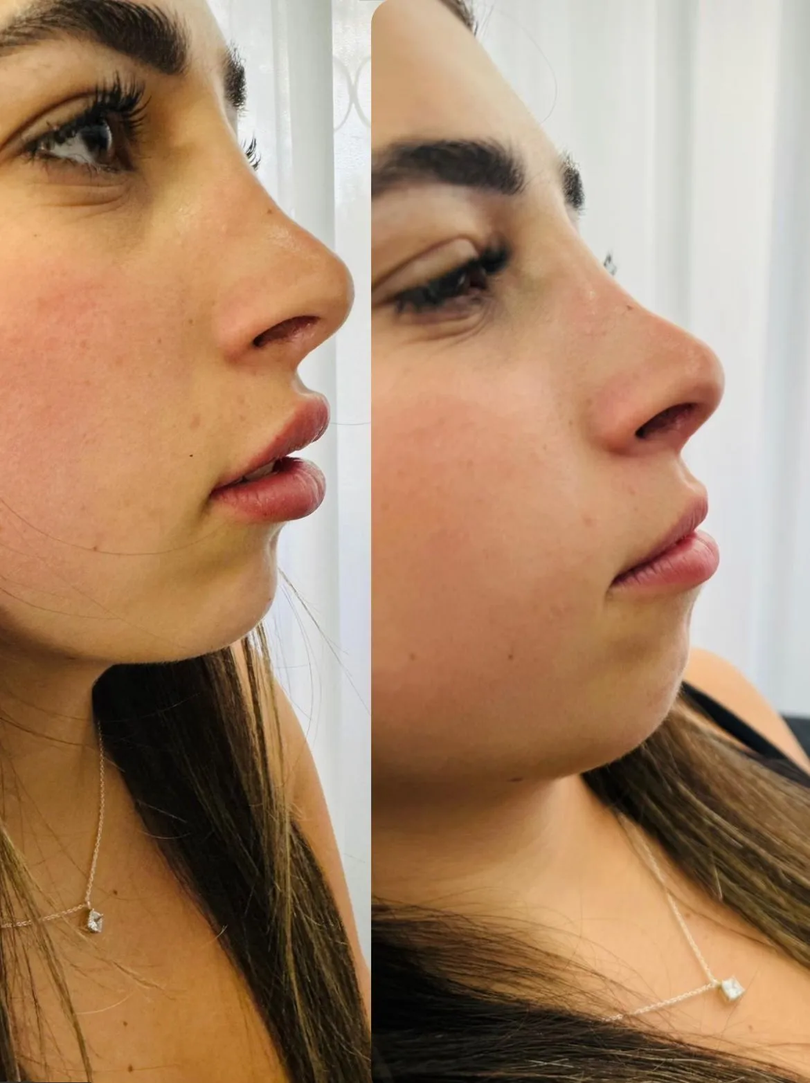 טיפולי אסתטיקה (הזרקות)