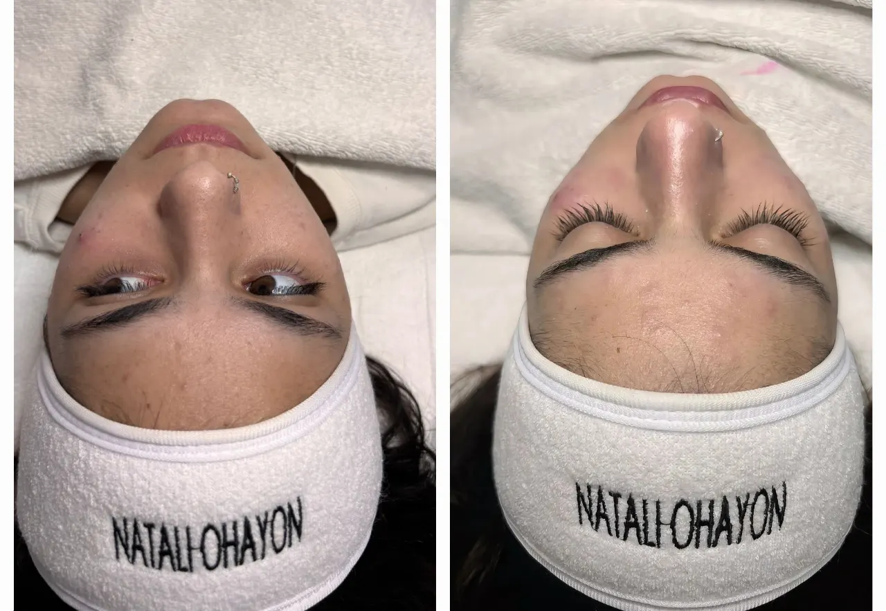 טיפול באקנה 