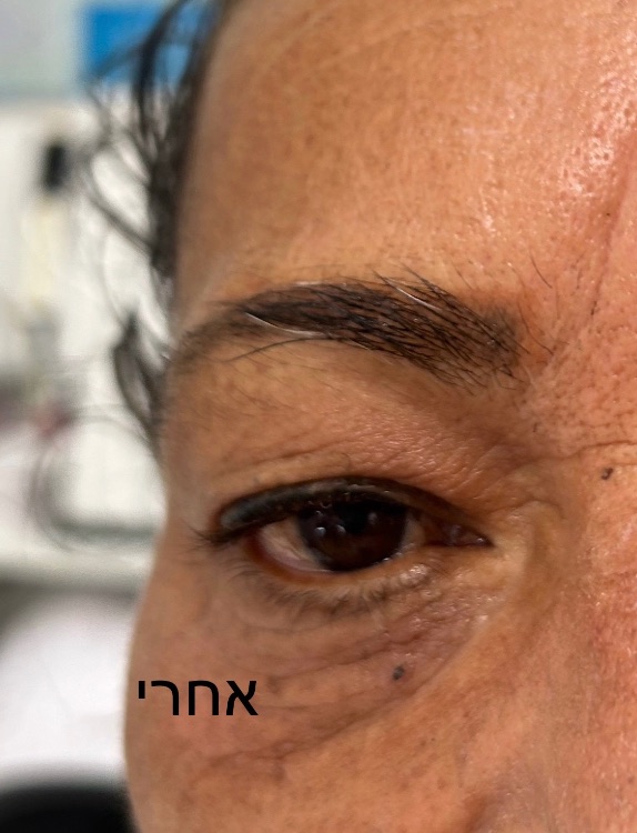 טיפול בקמטים /פלמה Dush פלזמה Nidel