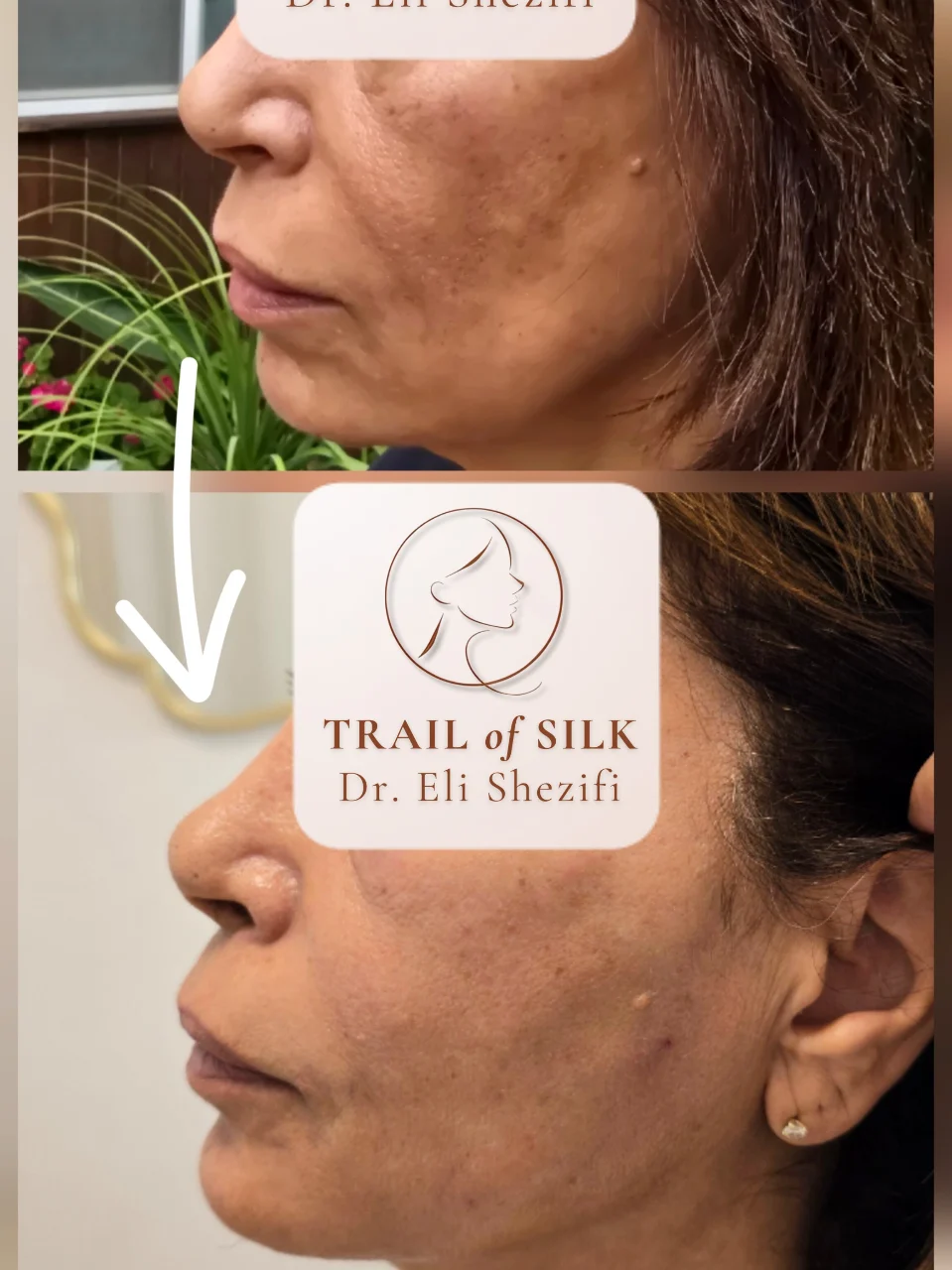 שיפור מרקם העור