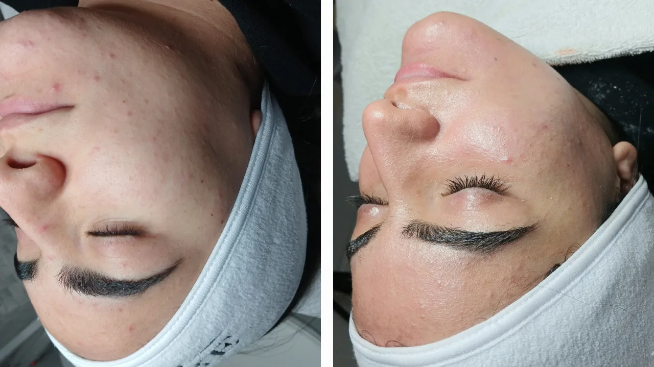  טיפול מיגור דלקת האקנה