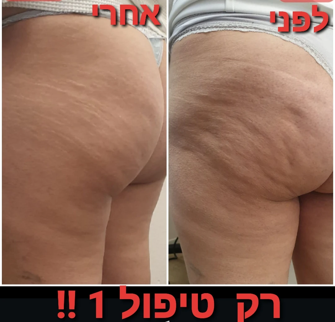 הפחתת צלוליט על ידי מכשיר גלי רדיו RF