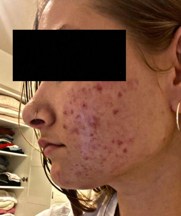 חבילת טיפול באקנה פרימיום