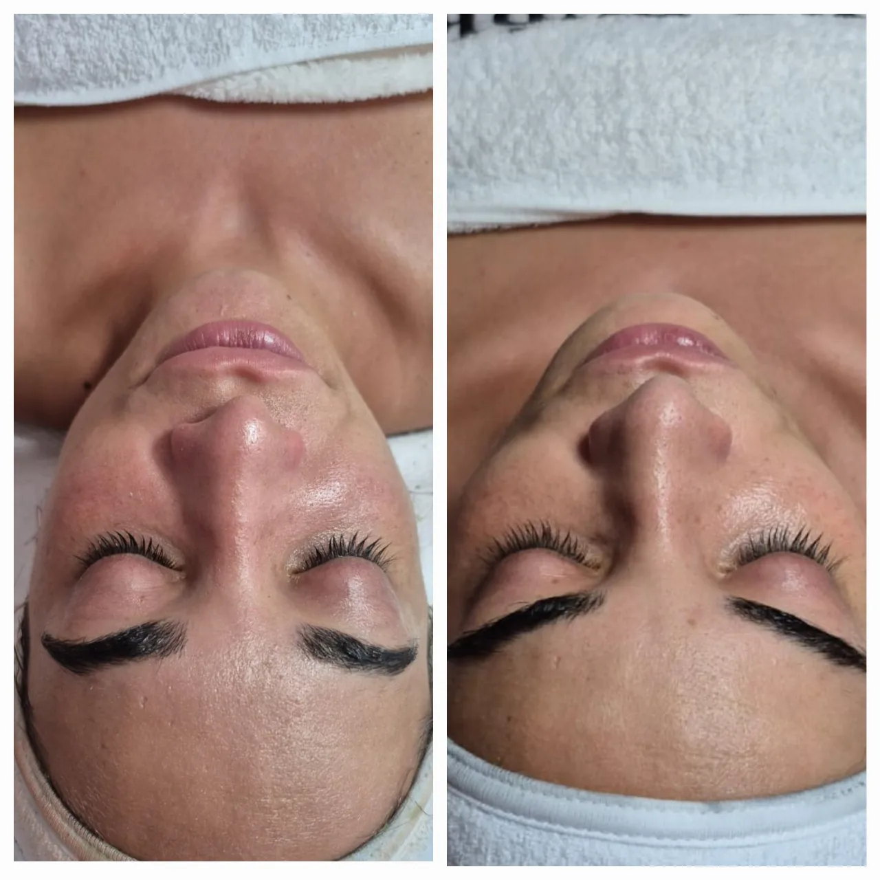 טיפול פנים קלאסי