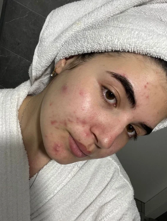 חבילת אקנה בייסיק