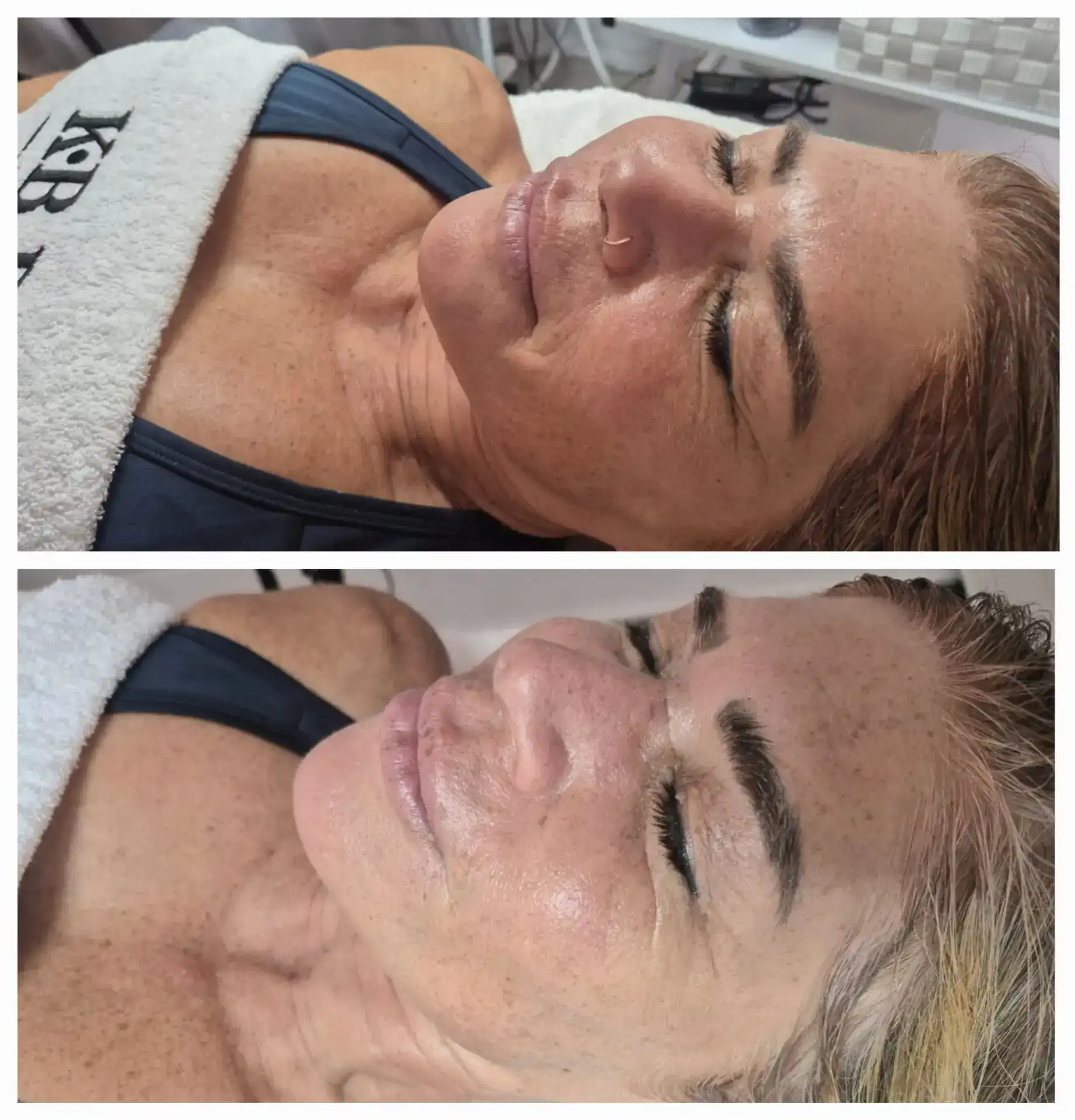 טיפול אנטיאייג'ינג ומיצוק העור בשיטת RF