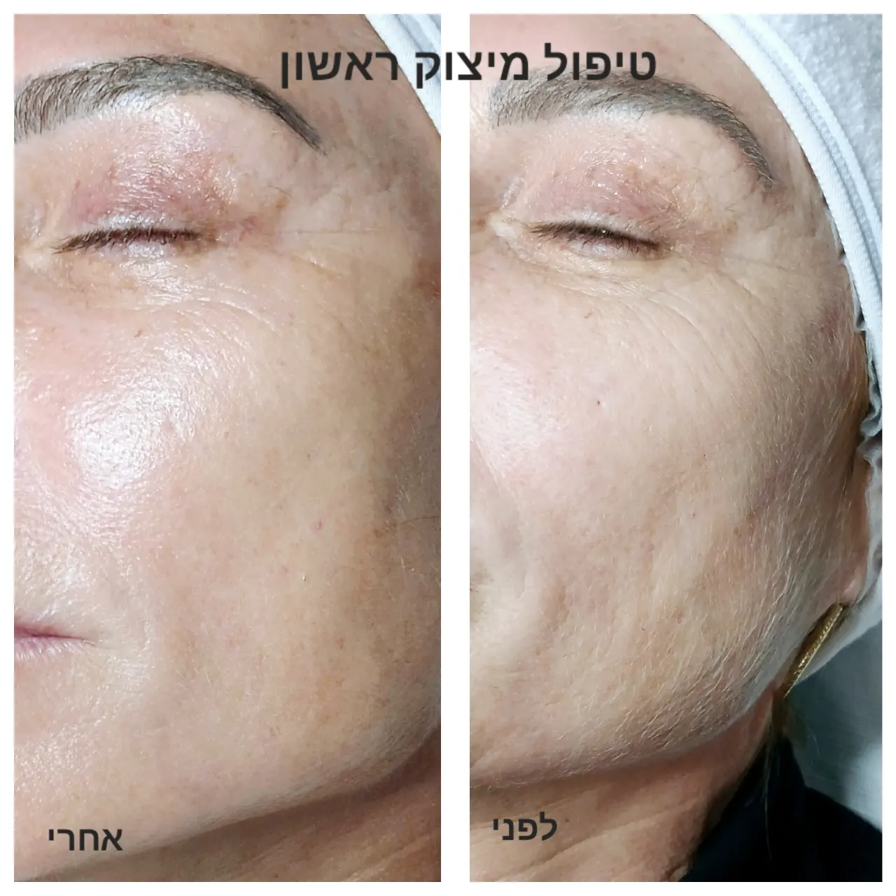 טיפול אייגינג  ומיצוק העור בשיטת RF