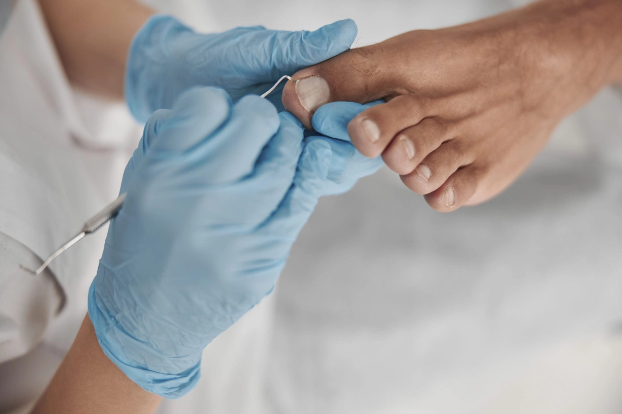 טיפול בציפורן חודרנית