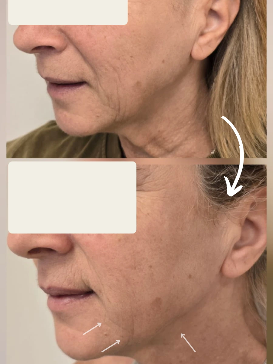 פיסול ועיצוב בחומצה היאלורונית