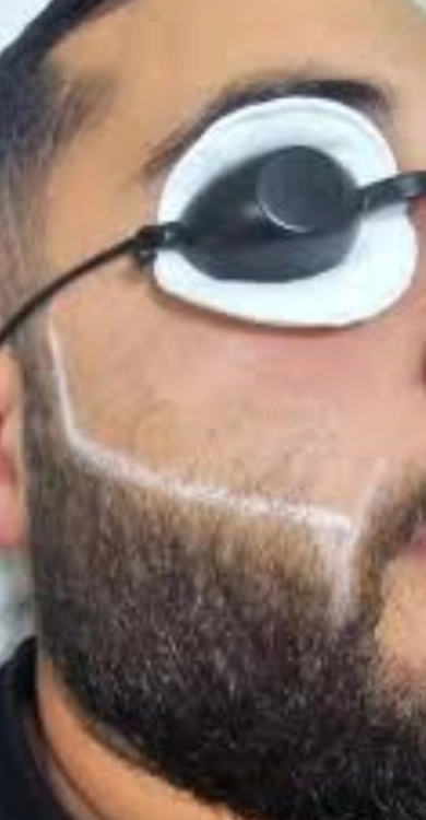 מכשור הלייזר שלנו - הסרת שיער לצמיתות!