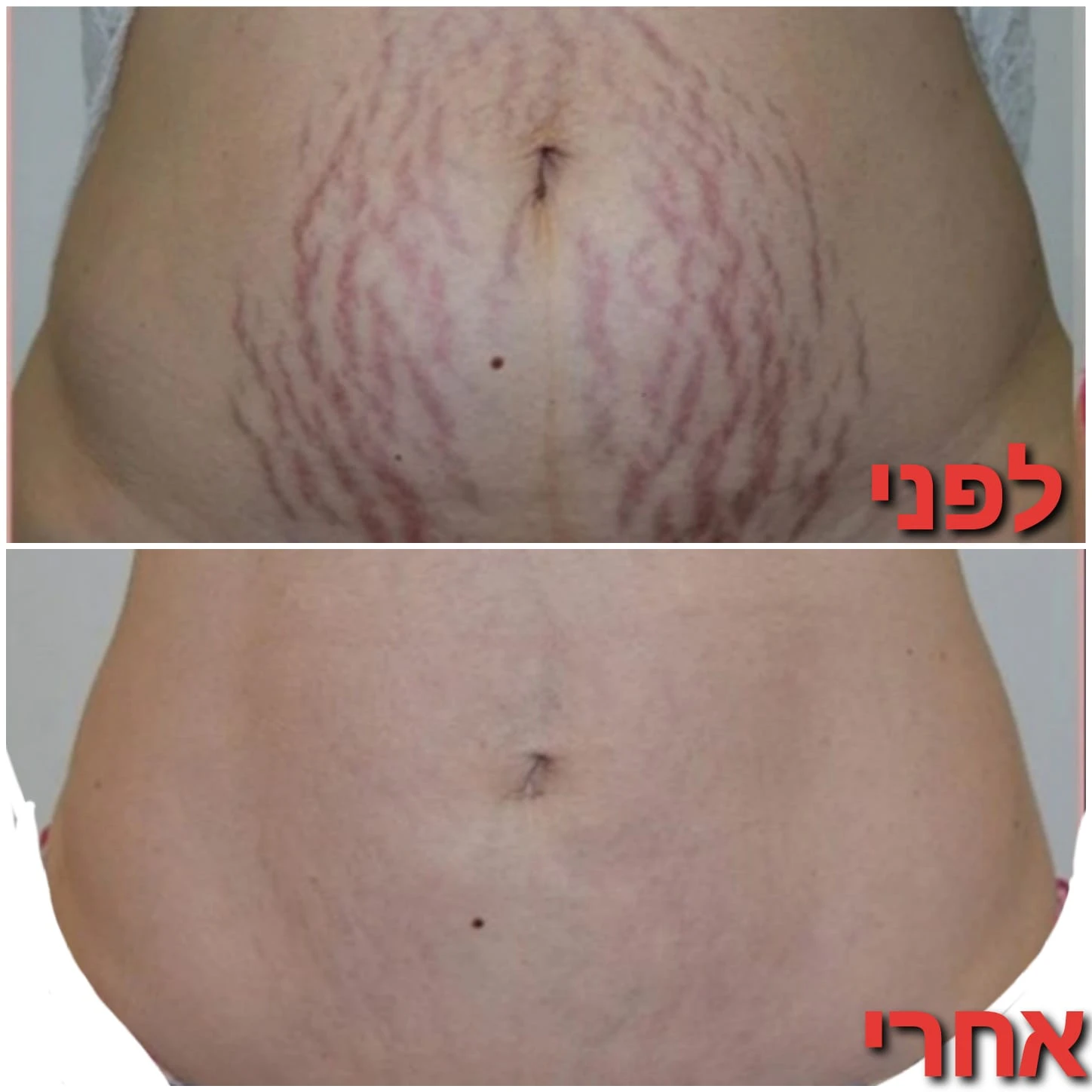 טיפולים לטישטוש סימני מתיחה וצלקות