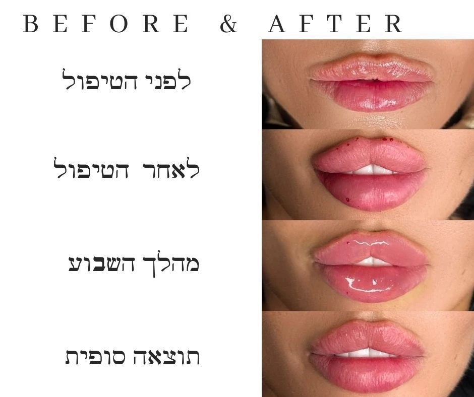 עיצוב שפתיים