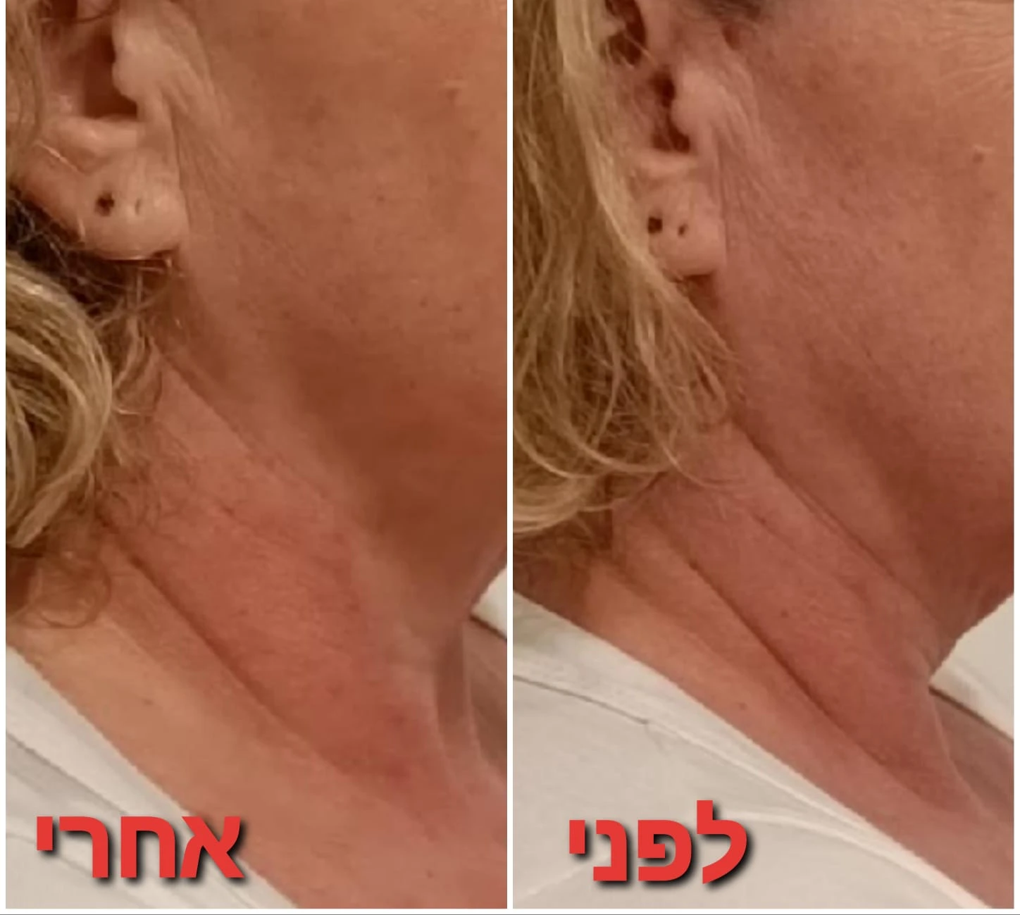 טיפולי פנים: אנטי אייגי'נג + גלי רדיו RF + מזותרפיה