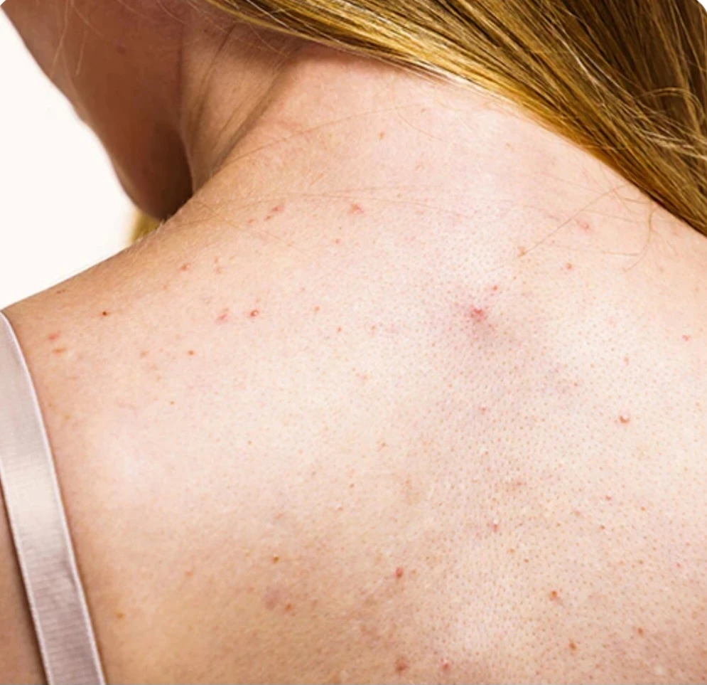 טיפול מקצועי לאקנה בגוף ברמת גן-לעור חלק ובריא