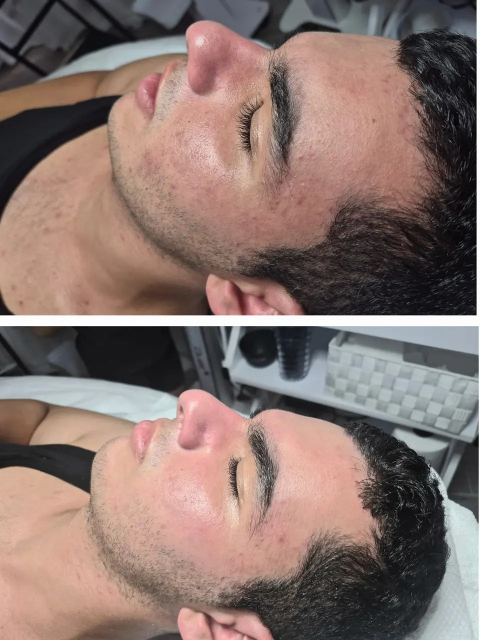  טיפול מיגור דלקת האקנה