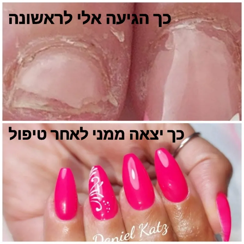שיקום ציפורניים - בנייה שיקומית