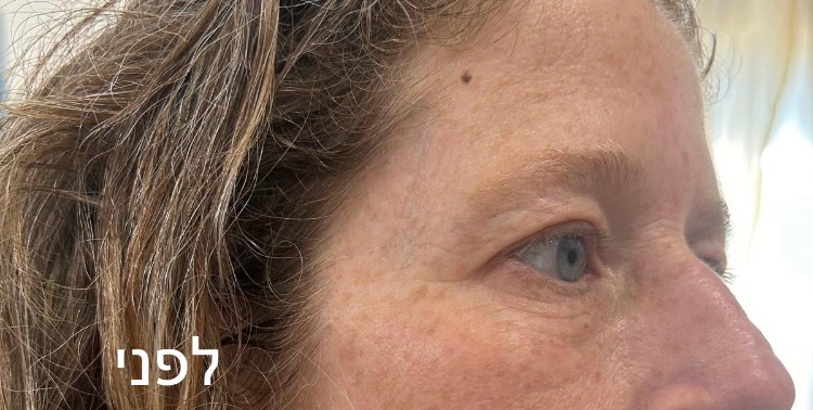 טיפול בקמטים /פלמה Dush פלזמה Nidel