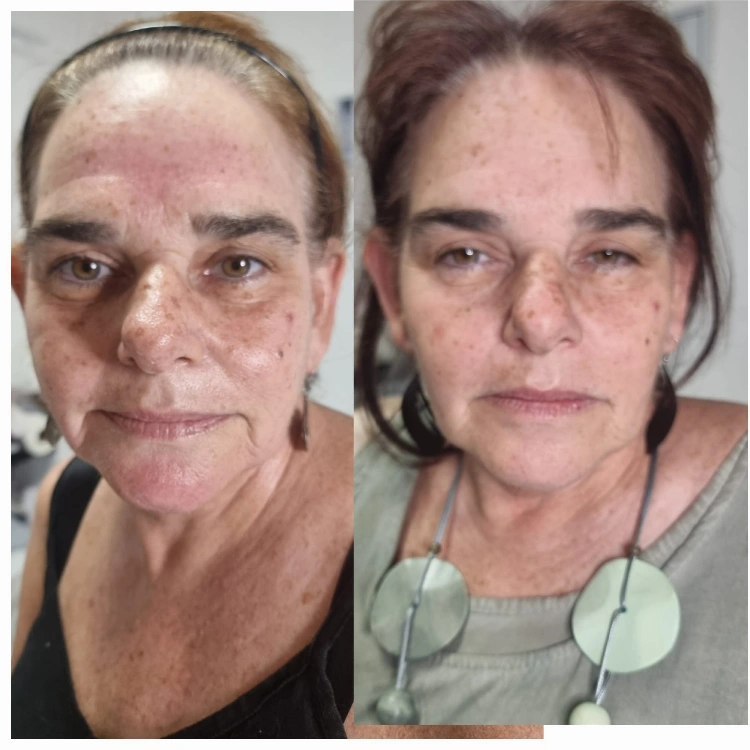 טיפולי RF למיצוק העור והעלמת קמטים