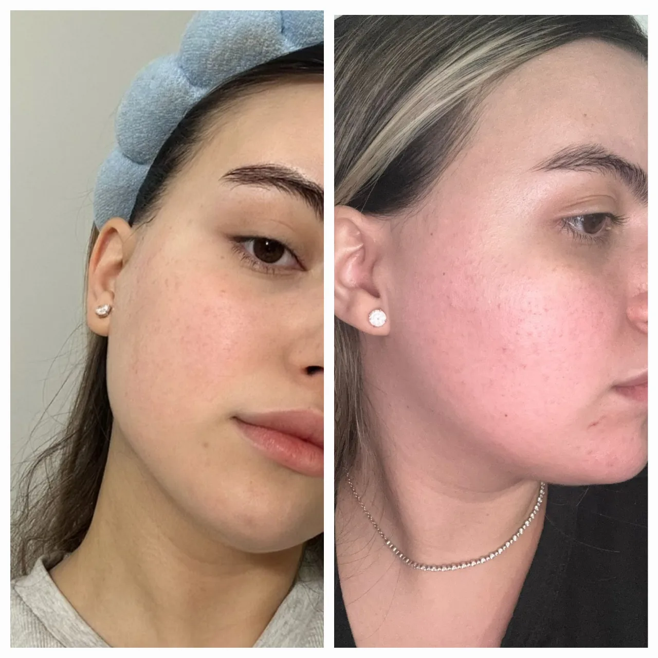 טיפול באקנה 