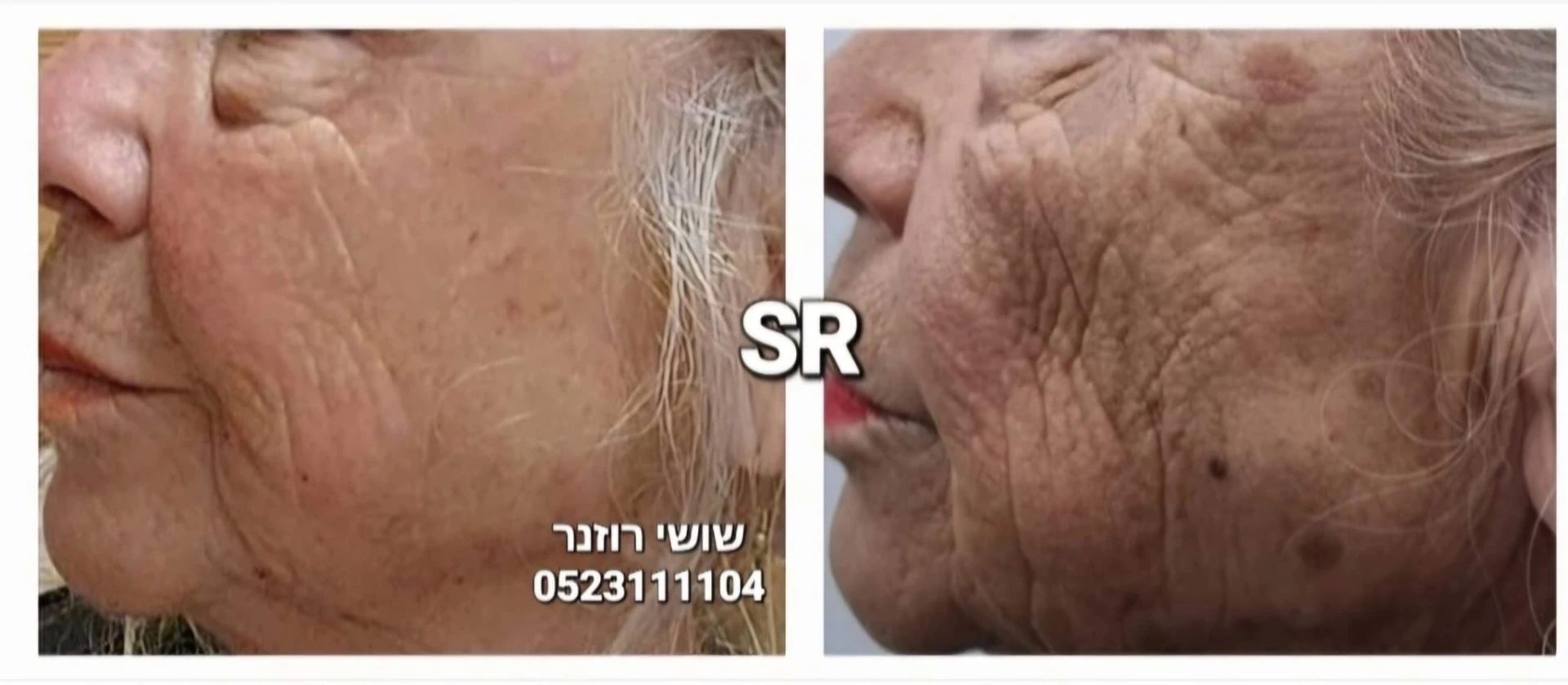 טיפול בפלזמה פיברובלסט