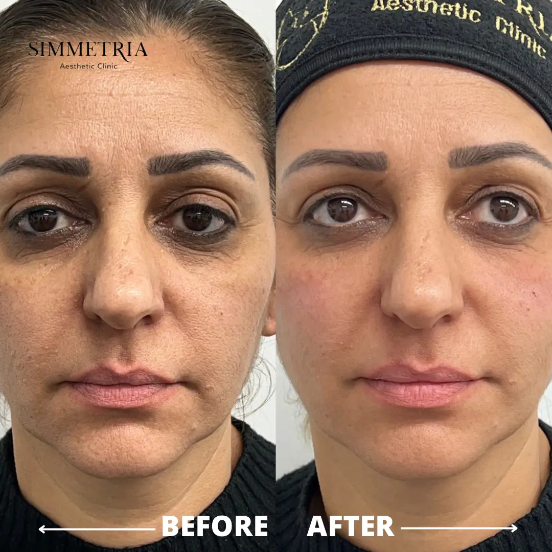 מילוי שקעי עיניים